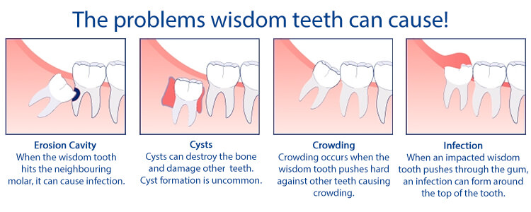 Diagram: wisdom teeth problems