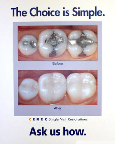 CEREC same day crowns example