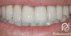 After Dentures Treatment