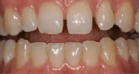 Before Dentures