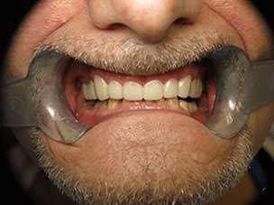 After Snap on Smile Treatment