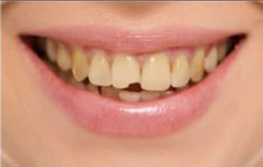 Before Teeth Whitening Treatment
