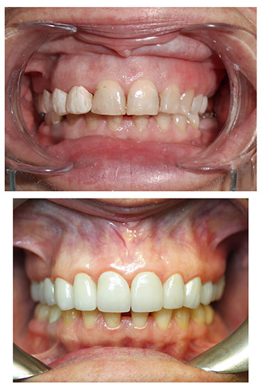 Before and after Smile Makeover procedure #1