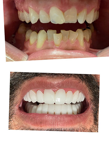 Before and after Smile Makeover procedure #2