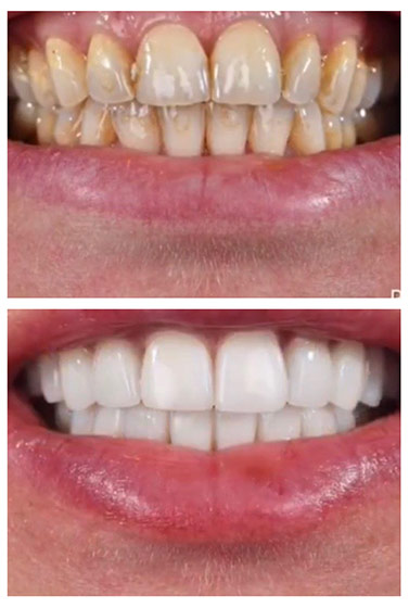 Before and after Smile Makeover procedure #3
