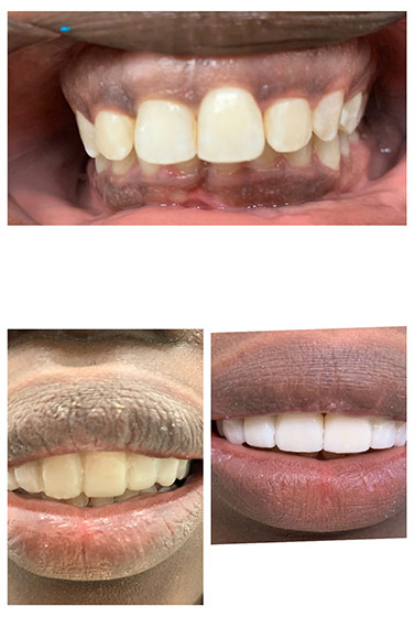 Before and after Smile Makeover procedure #4