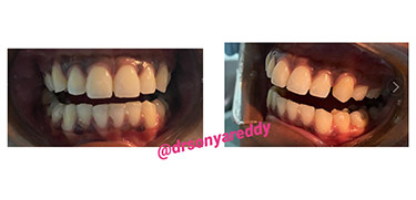 Before and after Smile Makeover procedure #6