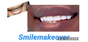 Before and after Smile Makeover procedure #7