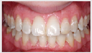 Invisalign after treatment #2