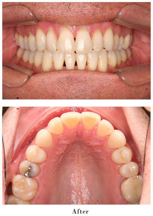 Invisalign after treatment #3