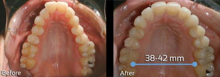 Vivos dental device results